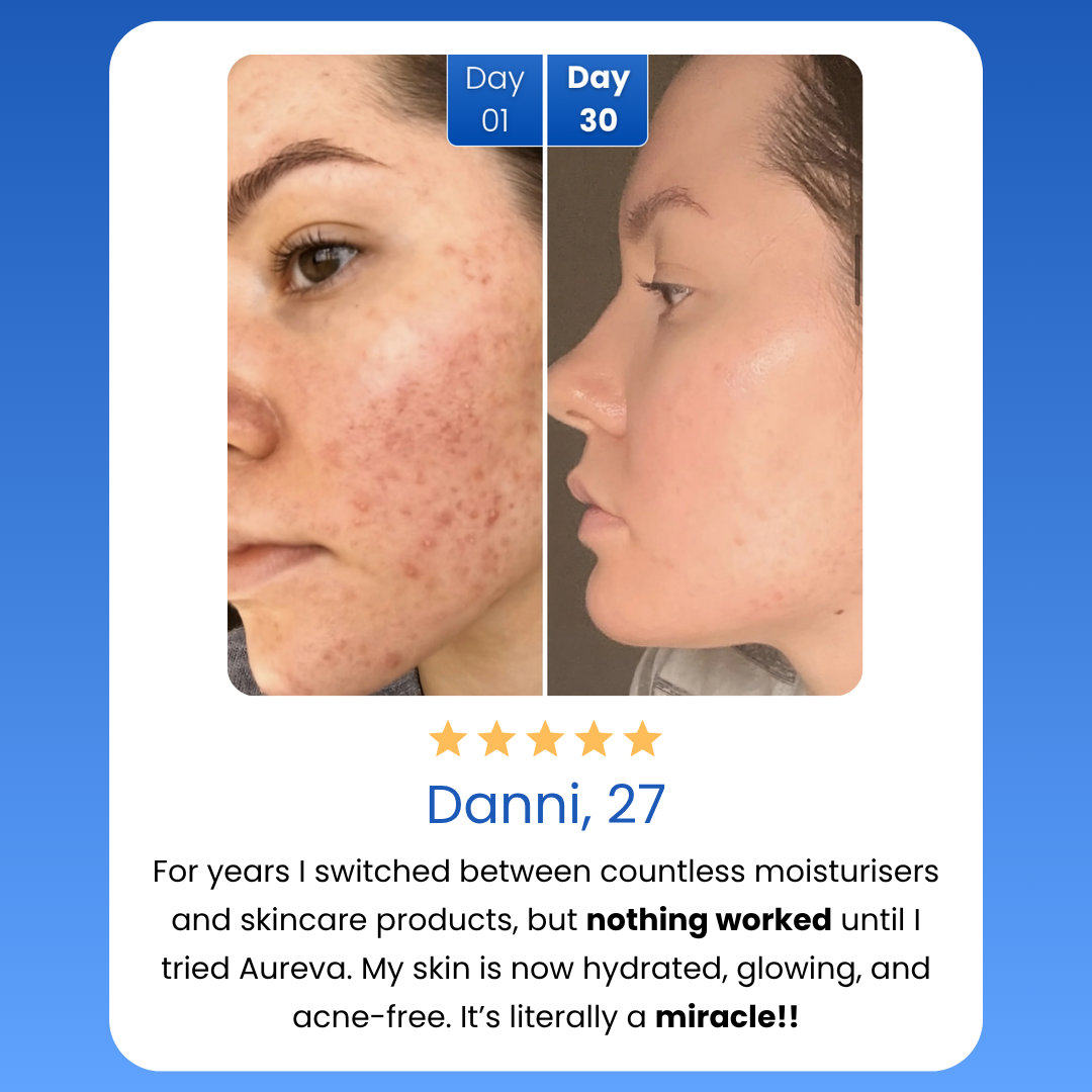 Before and after comparison of a person's face with acne, showing improvement over 30 days, with a five-star review from Danni, 27.